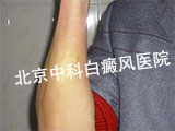 白癜风会不会传染